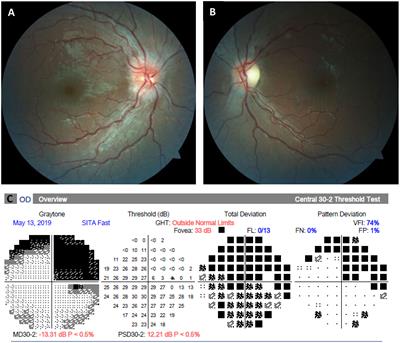 Frontiers in Ophthalmology | Articles